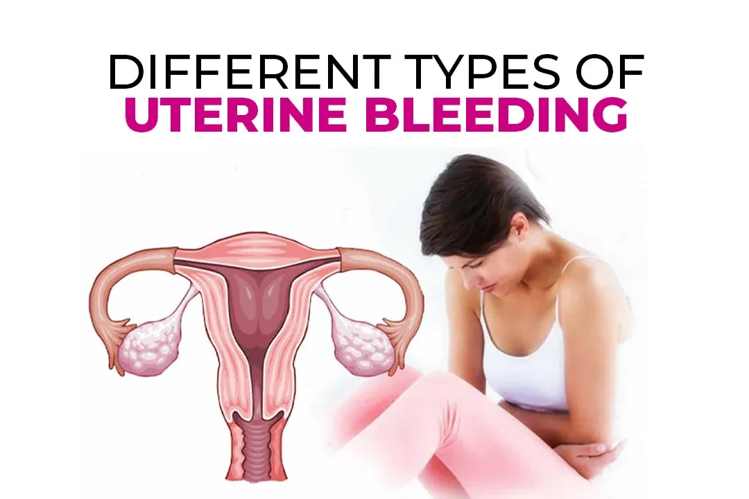 Different Types of Uterine Bleeding