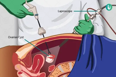 Laparoscopic Ovarian Cystectomy
