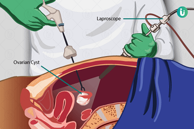 Ovarian Cystectomy |Image